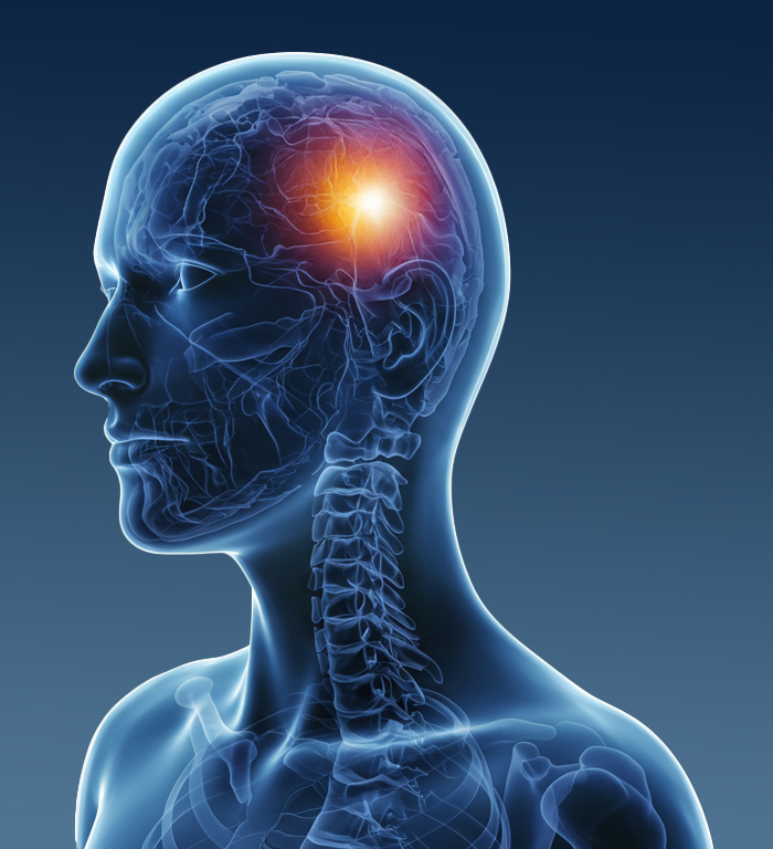 tms for migraines